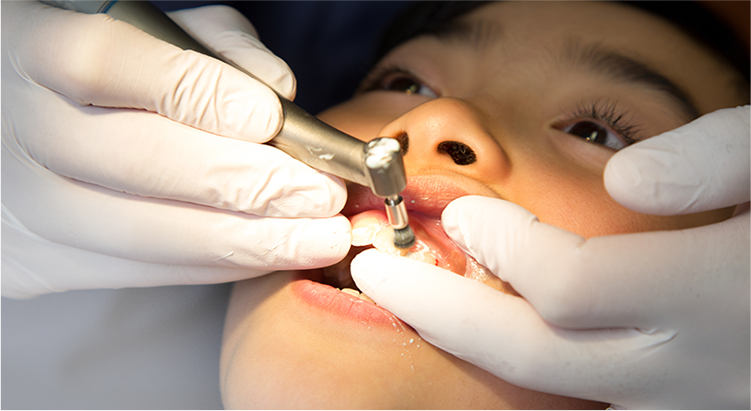 矯正治療中の歯のクリーニング費用1回1,000～2,000円程度(保険)月1回ご来院ください